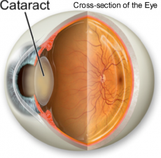 Which Cataract Surgery Instruments Are Used in Ophthalmic Procedures ...